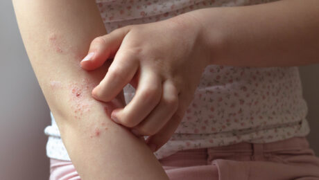 A child scratching an eczema