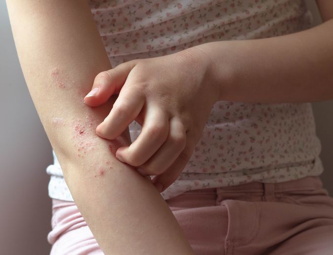 Natural Eczema Relief: Triggers, Gut Health & Skincare That Supports Lasting Relief